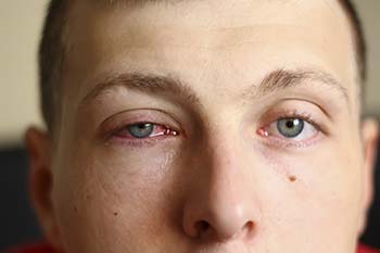 Recognizing Resin Poisoning Symptoms: A Guide for Craft Enthusiasts 4 Close-up of a person's face with a swollen and red eye due to an allergic reaction.