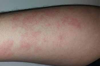 Recognizing Resin Poisoning Symptoms: A Guide for Craft Enthusiasts 3 Close-up of an arm with red, irritated skin likely due to a chemical burn.